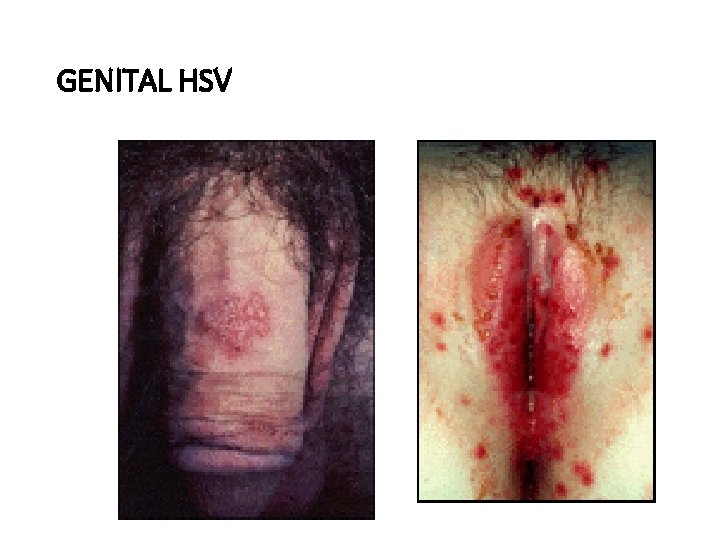 GENITAL HSV 