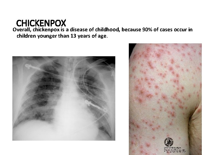 CHICKENPOX Overall, chickenpox is a disease of childhood, because 90% of cases occur in