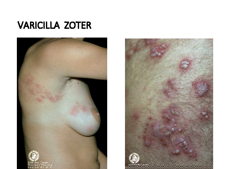 VARICILLA ZOTER 