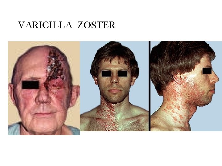 VARICILLA ZOSTER 
