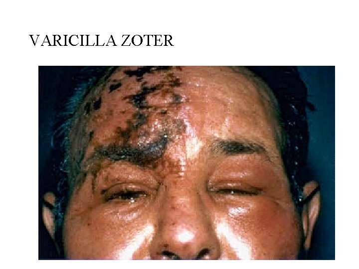 VARICILLA ZOTER 