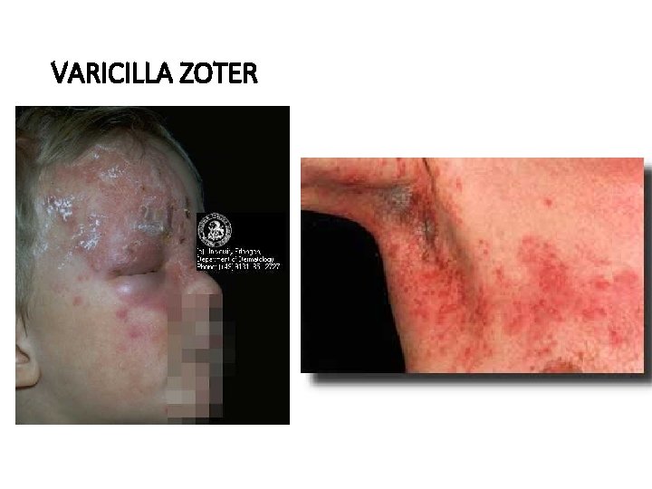 VARICILLA ZOTER 