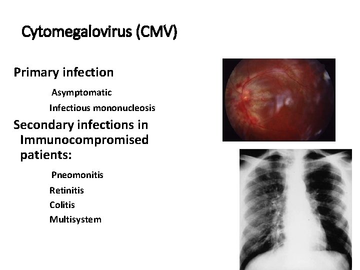 Cytomegalovirus (CMV) Primary infection Asymptomatic Infectious mononucleosis Secondary infections in Immunocompromised patients: Pneomonitis Retinitis