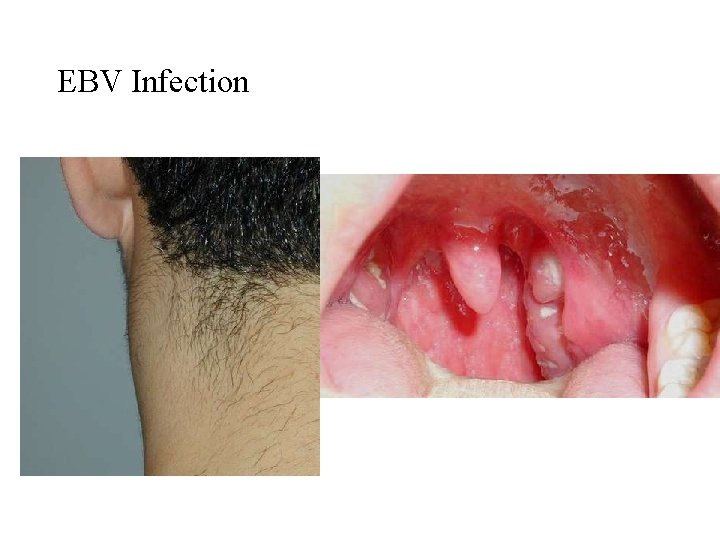 EBV Infection 