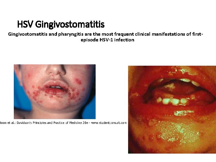 HSV Gingivostomatitis and pharyngitis are the most frequent clinical manifestations of firstepisode HSV-1 infection