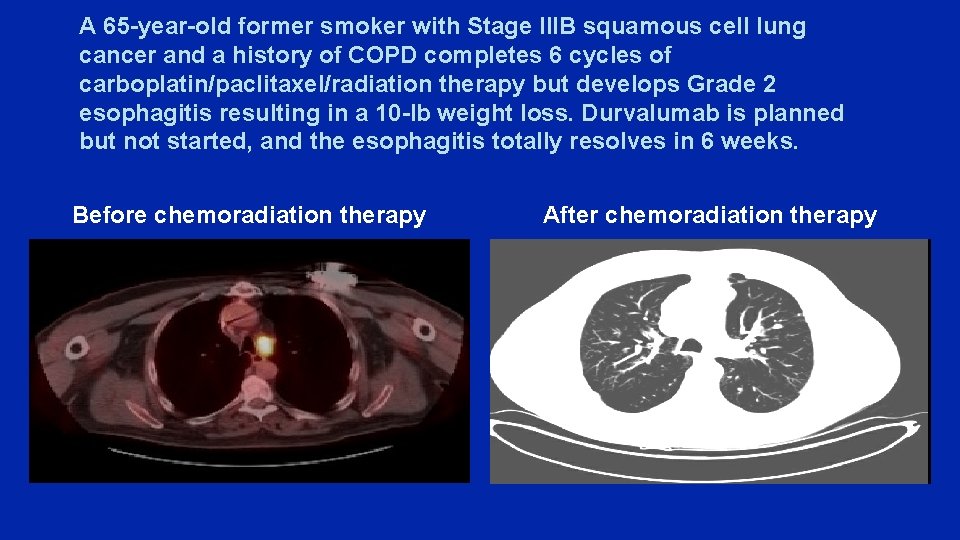 A 65 -year-old former smoker with Stage IIIB squamous cell lung cancer and a