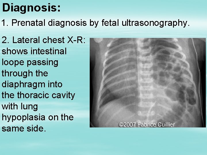 Diagnosis: 1. Prenatal diagnosis by fetal ultrasonography. 2. Lateral chest X-R: shows intestinal loope