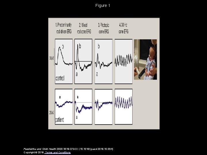 Figure 1 Paediatrics and Child Health 2020 3019 -27 DOI: (10. 1016/j. paed. 2019.