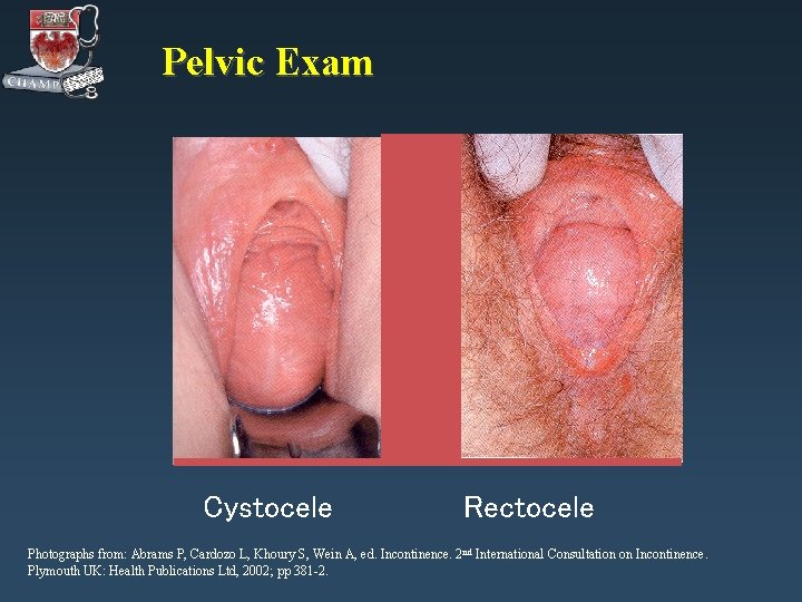 Pelvic Exam Cystocele Rectocele Photographs from: Abrams P, Cardozo L, Khoury S, Wein A,