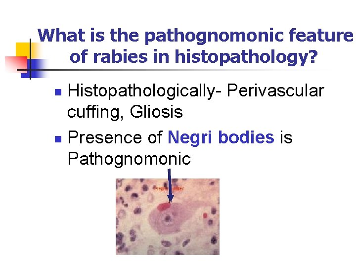 What is the pathognomonic feature of rabies in histopathology? Histopathologically- Perivascular cuffing, Gliosis n