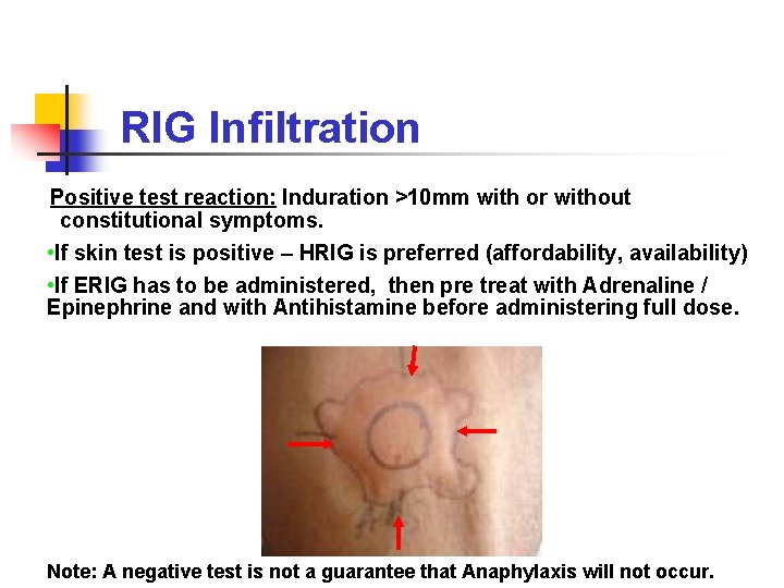 RIG Infiltration Positive test reaction: Induration >10 mm with or without constitutional symptoms. •