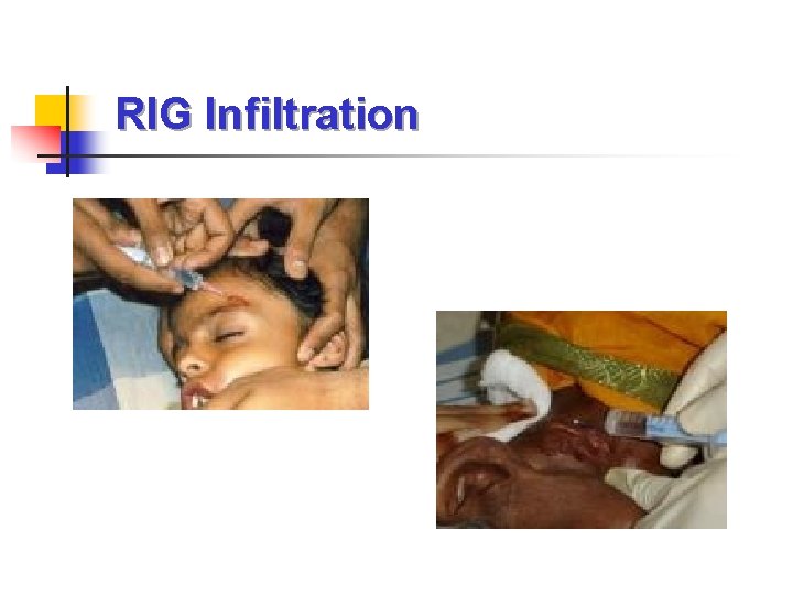 RIG Infiltration 