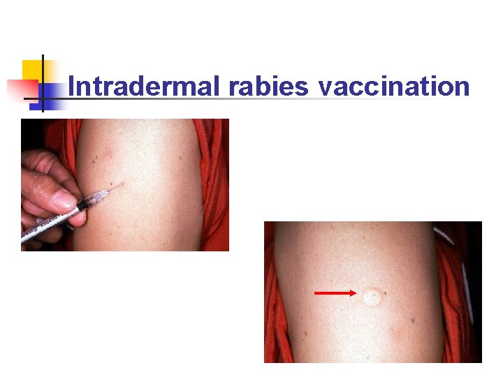 Intradermal rabies vaccination 