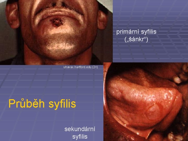 primární syfilis („šánkr“) uhavax. hartford. edu (2×) Průběh syfilis sekundární syfilis 