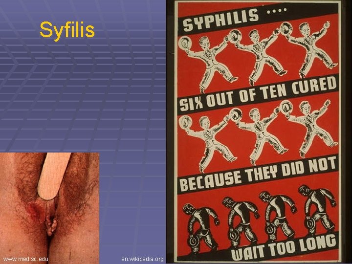 Syfilis www. med. sc. edu en. wikipedia. org 