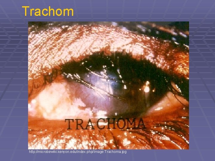 Trachom http: //microbewiki. kenyon. edu/index. php/Image: Trachoma. jpg 