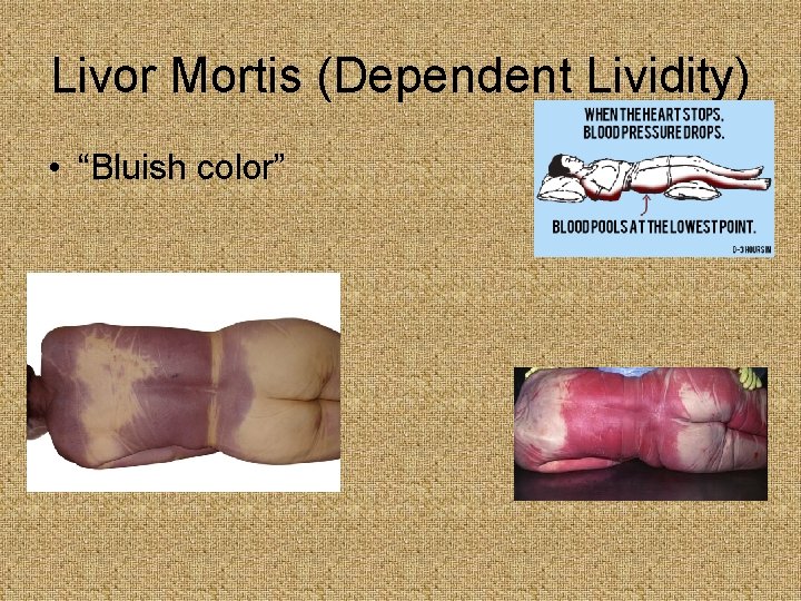 Livor Mortis (Dependent Lividity) • “Bluish color” 