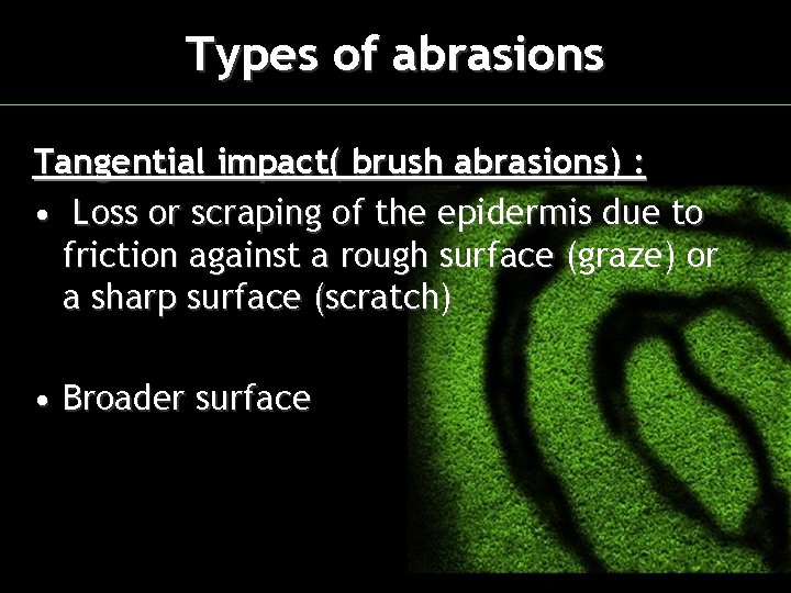 Types of abrasions Tangential impact( brush abrasions) : • Loss or scraping of the