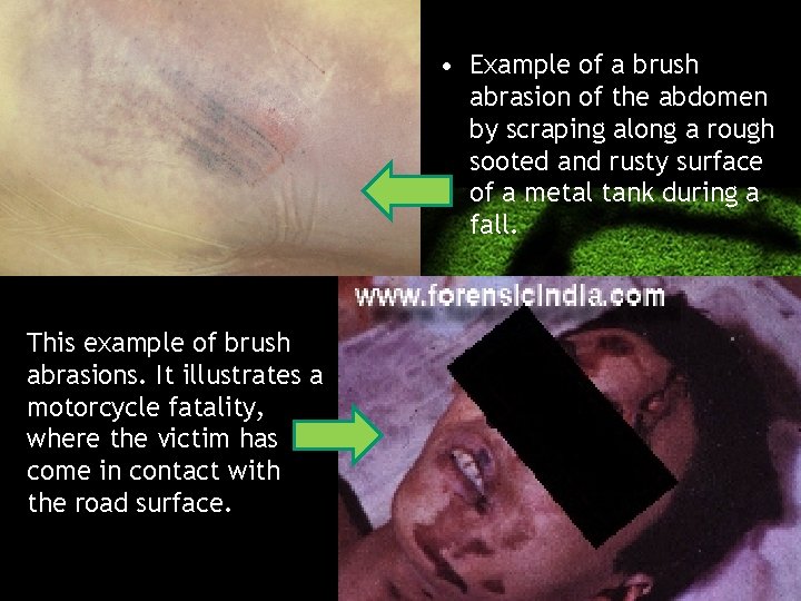  • Example of a brush abrasion of the abdomen by scraping along a