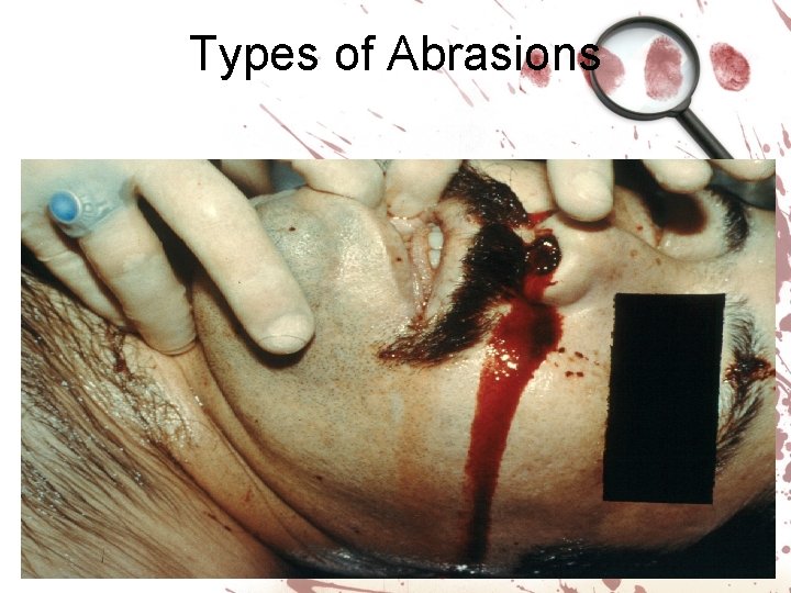 Types of Abrasions 