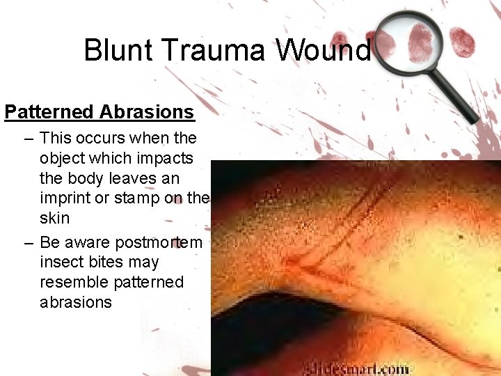 Blunt Trauma Wound Patterned Abrasions – This occurs when the object which impacts the