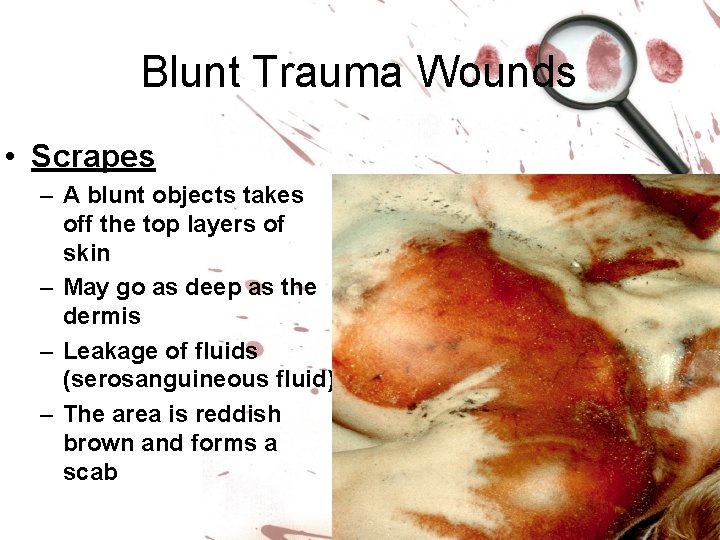 Blunt Trauma Wounds • Scrapes – A blunt objects takes off the top layers