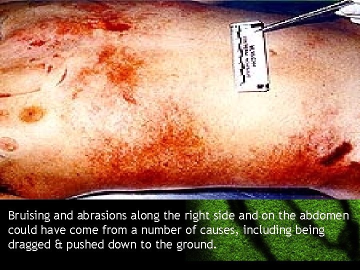 Bruising and abrasions along the right side and on the abdomen could have come