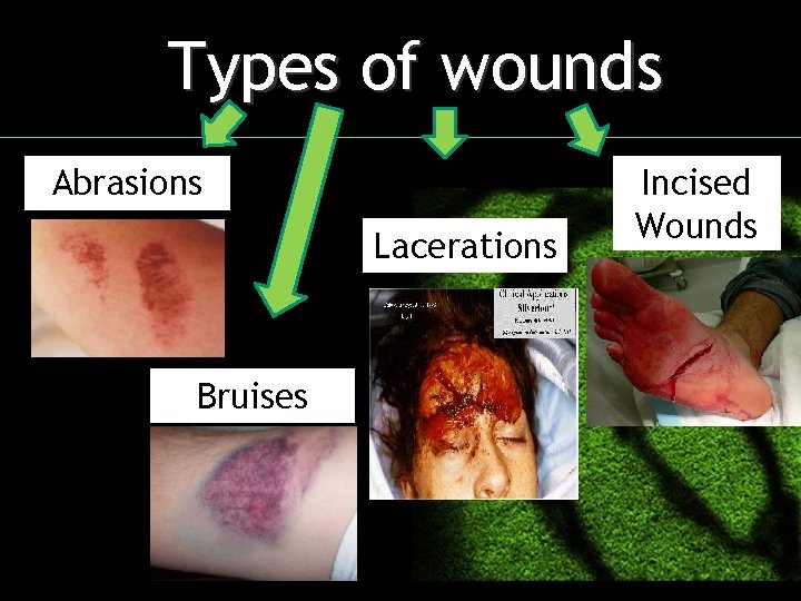 Types of wounds Abrasions Lacerations Bruises Incised Wounds 