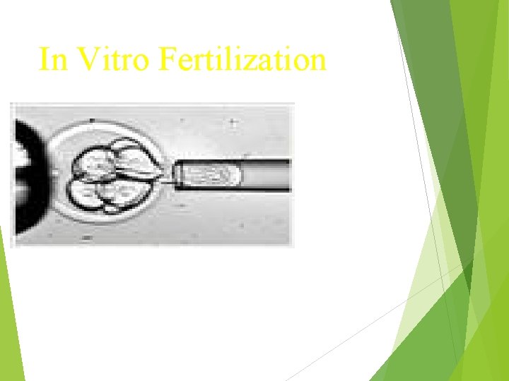 In Vitro Fertilization 