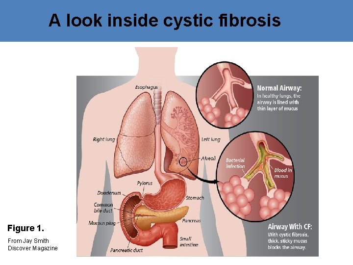 A look inside cystic fibrosis Figure 1. From Jay Smith Discover Magazine 