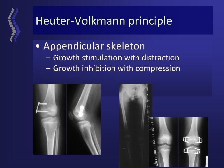 Heuter-Volkmann principle • Appendicular skeleton – Growth stimulation with distraction – Growth inhibition with