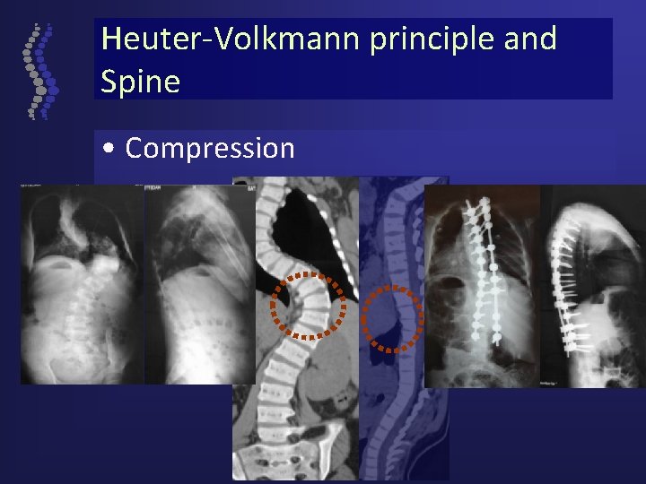 Heuter-Volkmann principle and Spine • Compression 