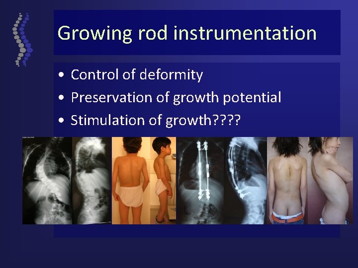 Growing rod instrumentation • Control of deformity • Preservation of growth potential • Stimulation