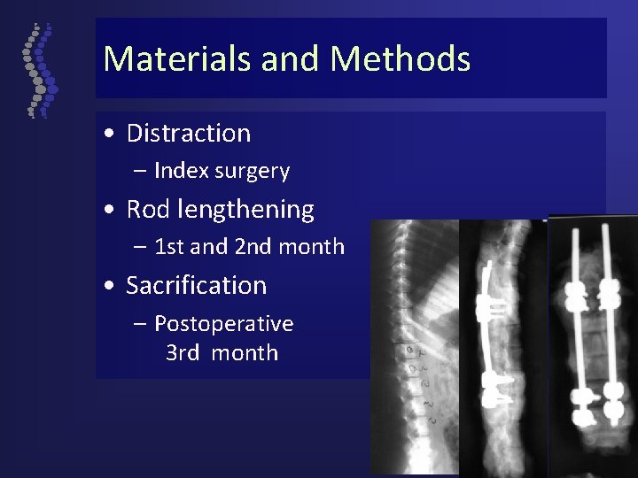 Materials and Methods • Distraction – Index surgery • Rod lengthening – 1 st