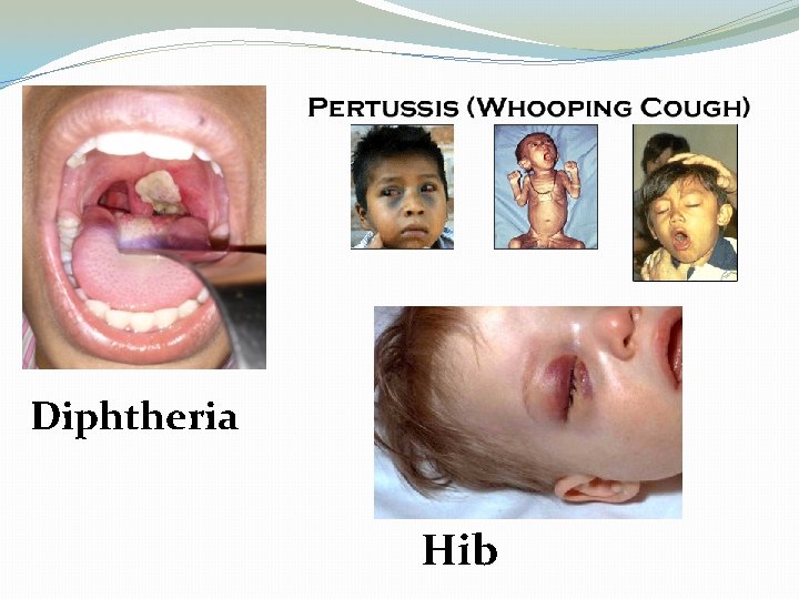 Diphtheria Hib 