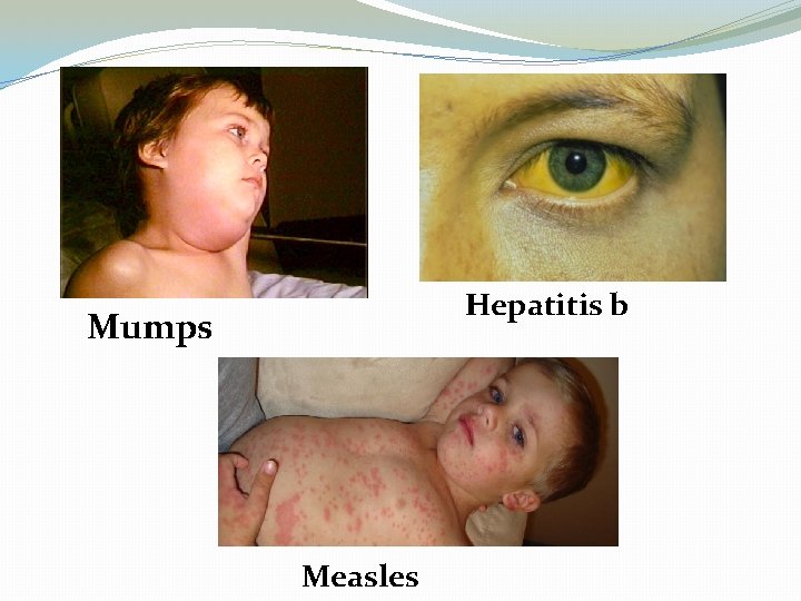 Hepatitis b Mumps Measles 