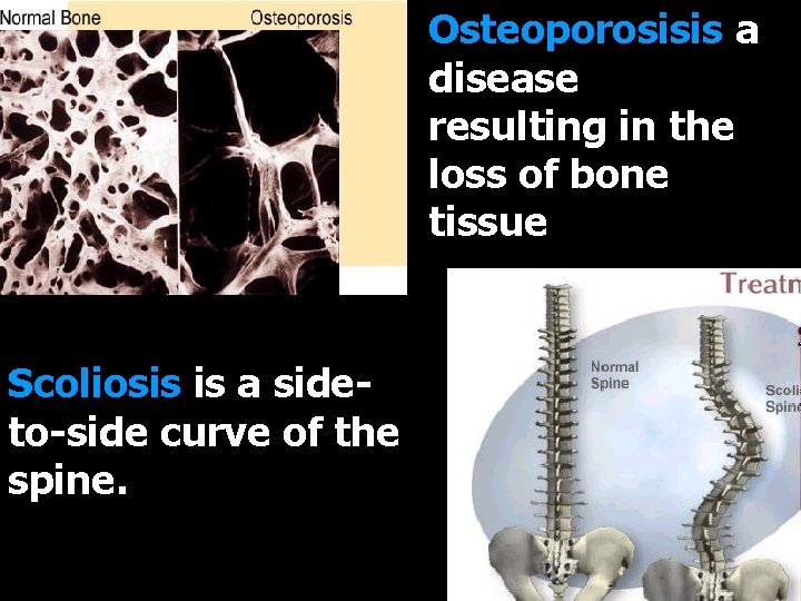 Osteoporosisis a disease resulting in the loss of bone tissue Scoliosis is a sideto-side