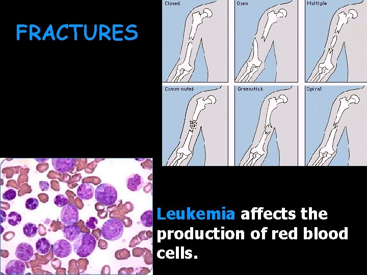 FRACTURES Leukemia affects the production of red blood cells. 