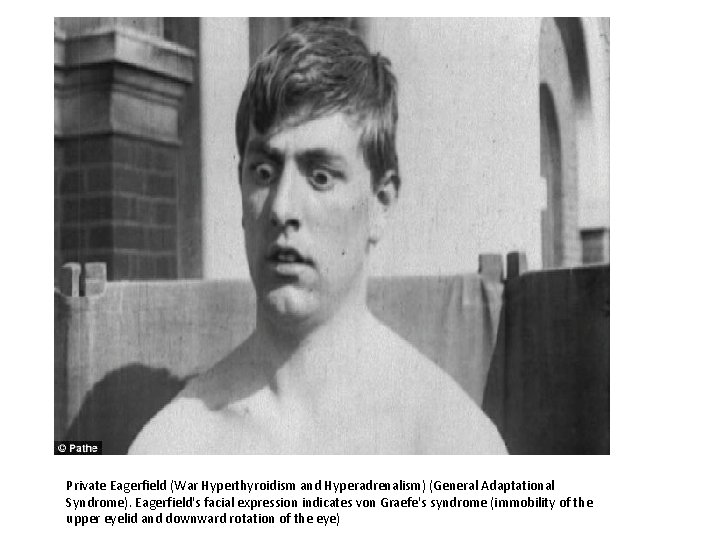 Private Eagerfield (War Hyperthyroidism and Hyperadrenalism) (General Adaptational Syndrome). Eagerfield's facial expression indicates von
