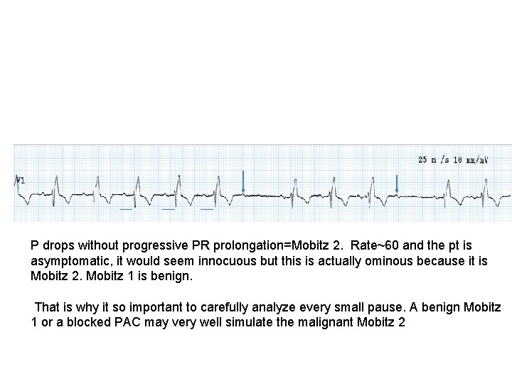 P drops without progressive PR prolongation=Mobitz 2. Rate~60 and the pt is asymptomatic, it