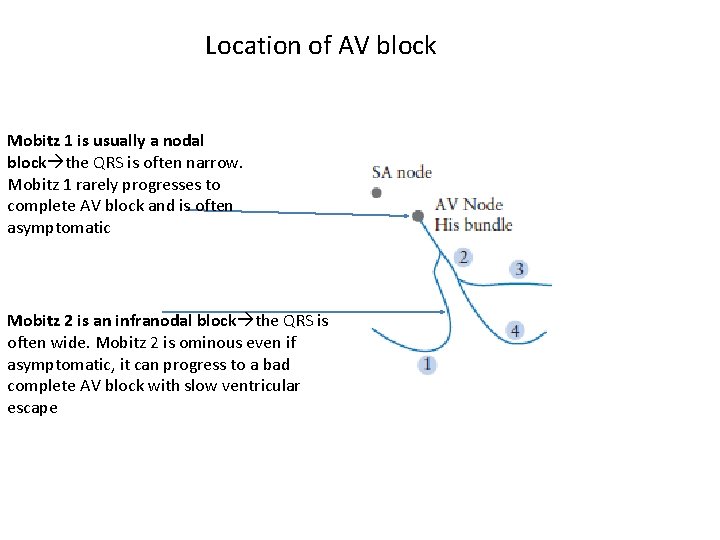 Location of AV block Mobitz 1 is usually a nodal block the QRS is