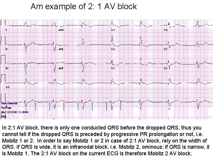 Am example of 2: 1 AV block In 2: 1 AV block, there is