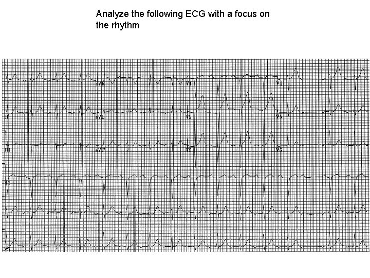 Analyze the following ECG with a focus on the rhythm 