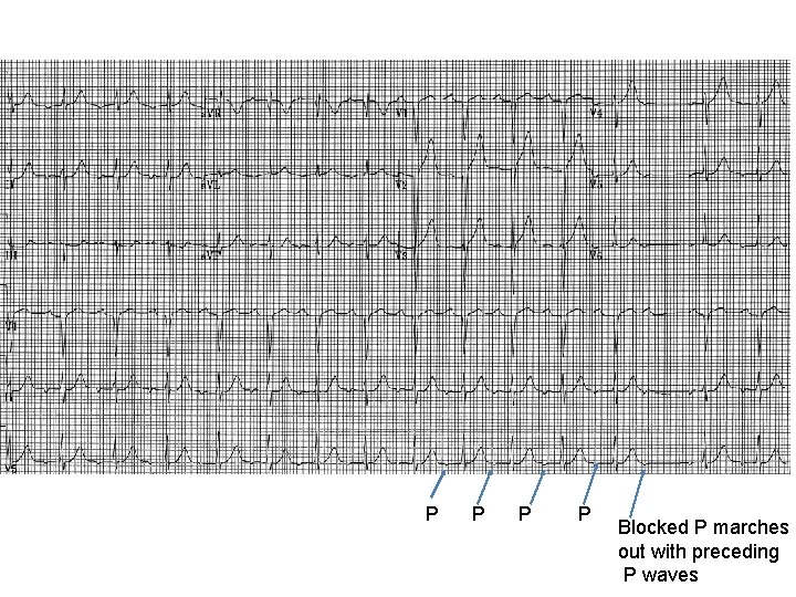 P P Blocked P marches out with preceding P waves 