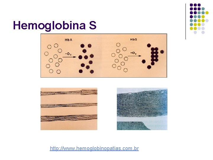 Hemoglobina S http: //www. hemoglobinopatias. com. br 