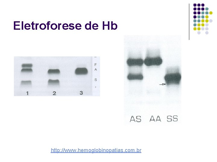 Eletroforese de Hb http: //www. hemoglobinopatias. com. br 