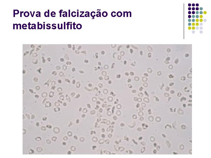 Prova de falcização com metabissulfito 