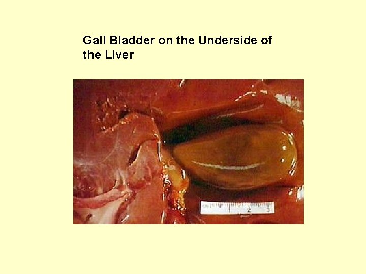 Gall Bladder on the Underside of the Liver 