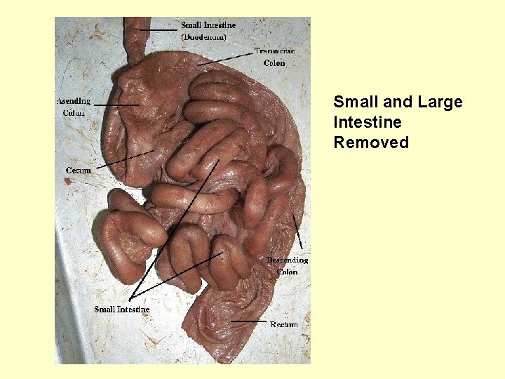 Small and Large Intestine Removed 