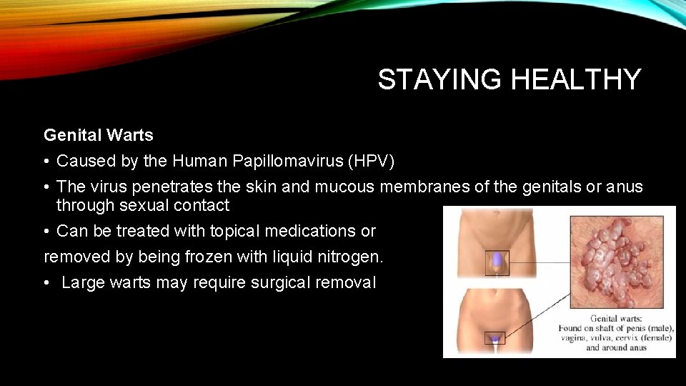 STAYING HEALTHY Genital Warts • Caused by the Human Papillomavirus (HPV) • The virus